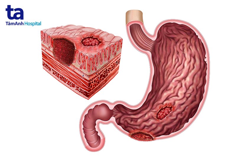 chữa viêm loét dạ dày