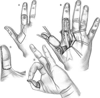 chuyển vạt da phục hồi