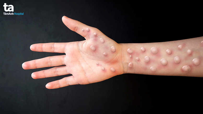 dấu hiệu đậu mùa khỉ