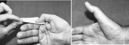 dấu hiệu froment và jeanne