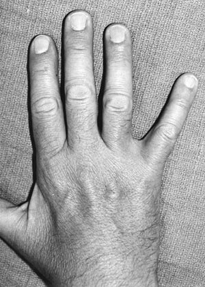 dấu hiệu mắc wartenberg