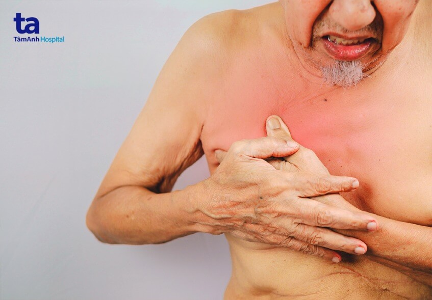 dấu hiệu ung thư vú ở nam giới