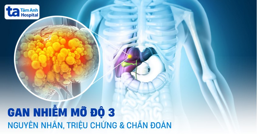 gan nhiễm mỡ độ 3