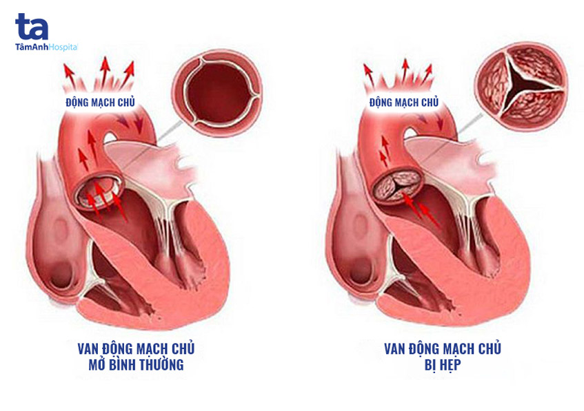 hẹp động mạch chủ