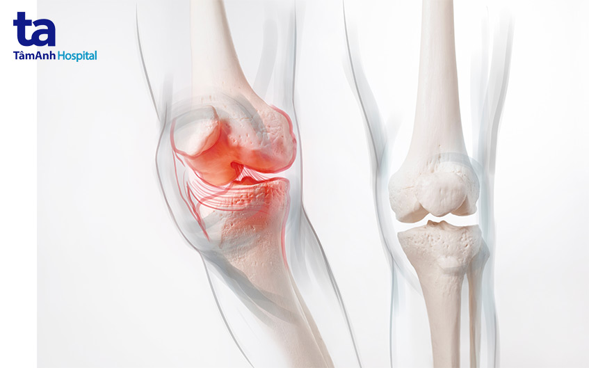 hẹp khe khớp là gì