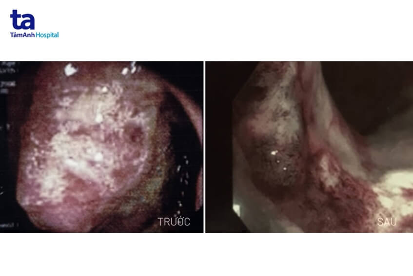 hình ảnh nội soi khối u đại tràng