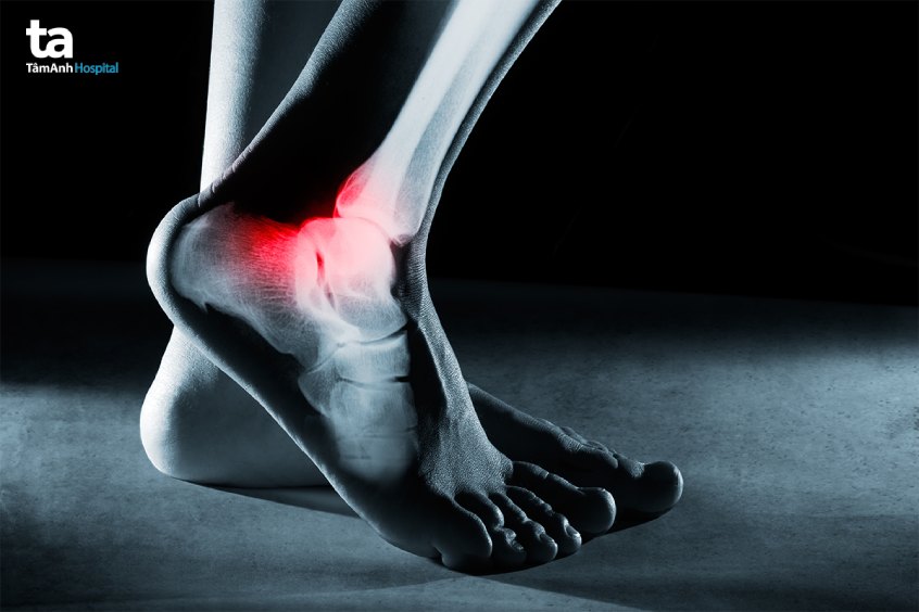 hình ảnh siêu âm khớp cổ chân chẩn đoán bệnh gì