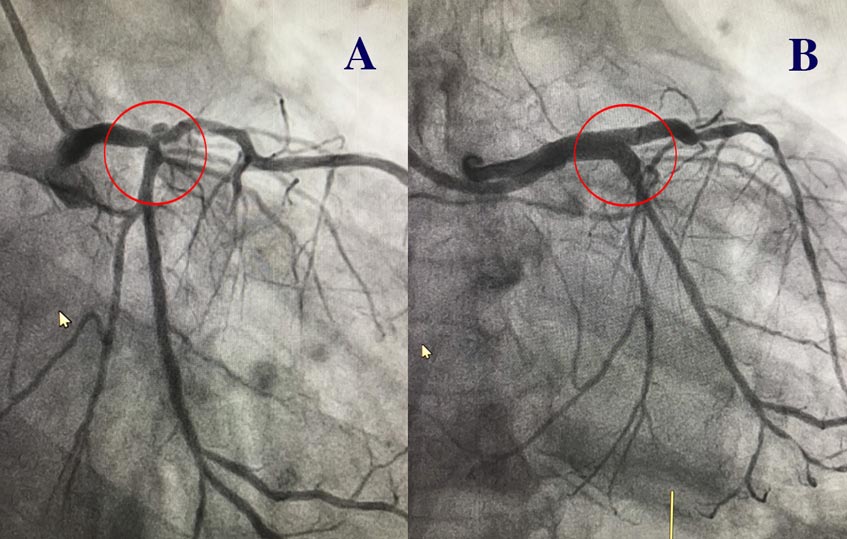 hình ảnh thân chung động mạch vành
