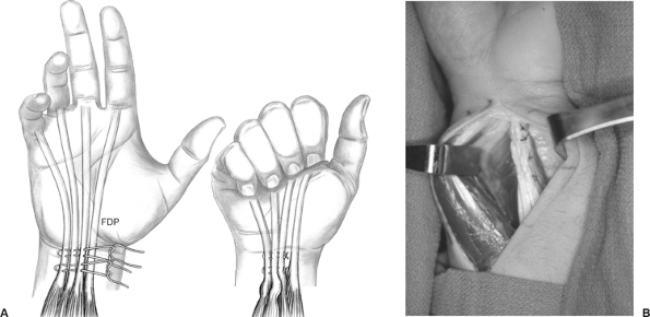 Hình 9: Kỹ thuật khâu phục hồi gấp ngón IV và V (Hand surgery, 2004)