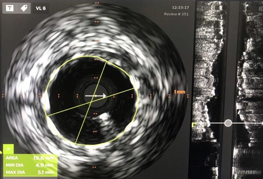 kích thước mạch máu