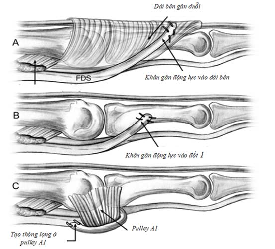 kỹ thuật cố định gân cơ động lực