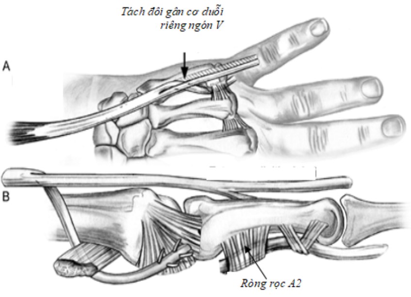 kỹ thuật khắc phục biến dạng giạng ngón V