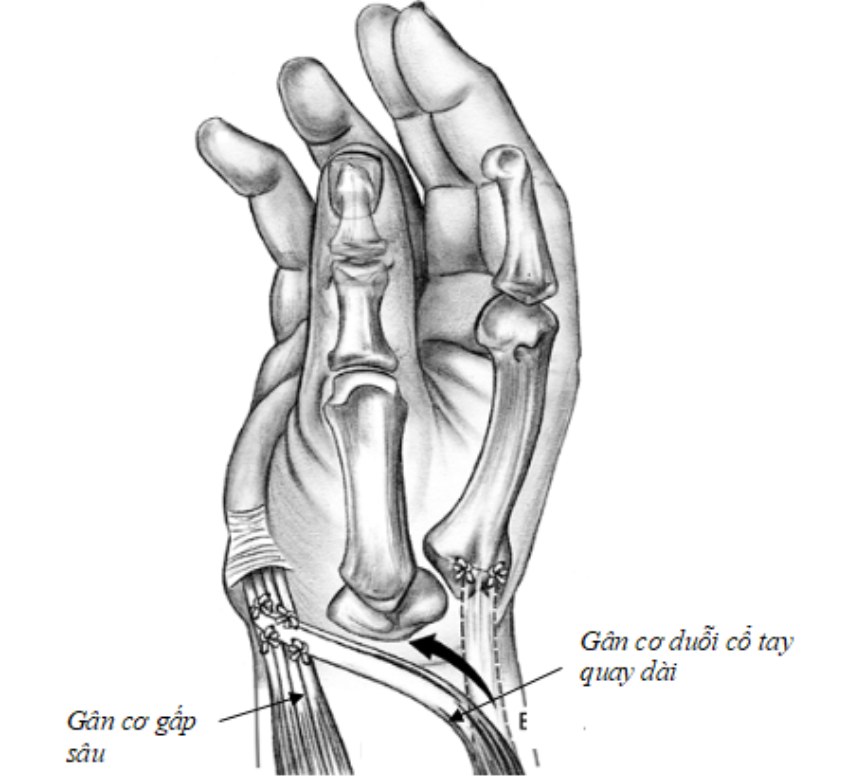 kỹ thuật lấy gân cơ duỗi cổ tay quay dài làm động lực gấp ngón