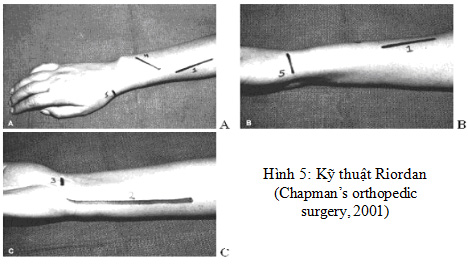 kỹ thuật riordan