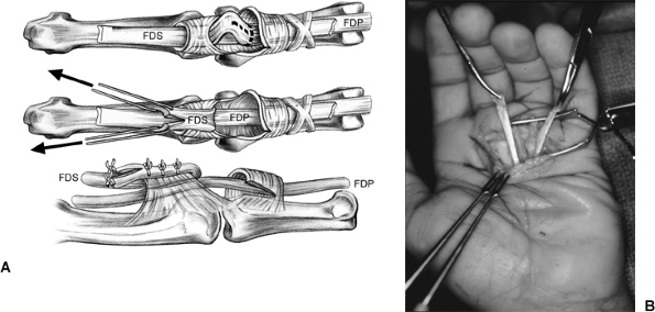 Hình 3: Kỹ thuật Zancolli lasso (Hand Surgery, 2004)