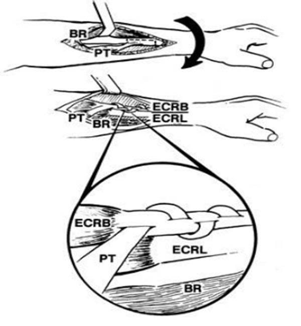 mối khâu pulvertaft