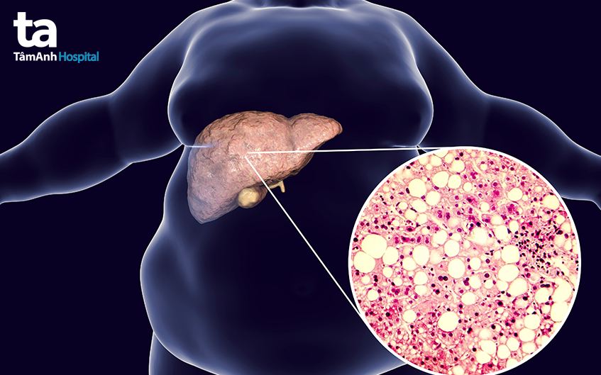 nguyên nhân gan nhiễm mỡ độ 3