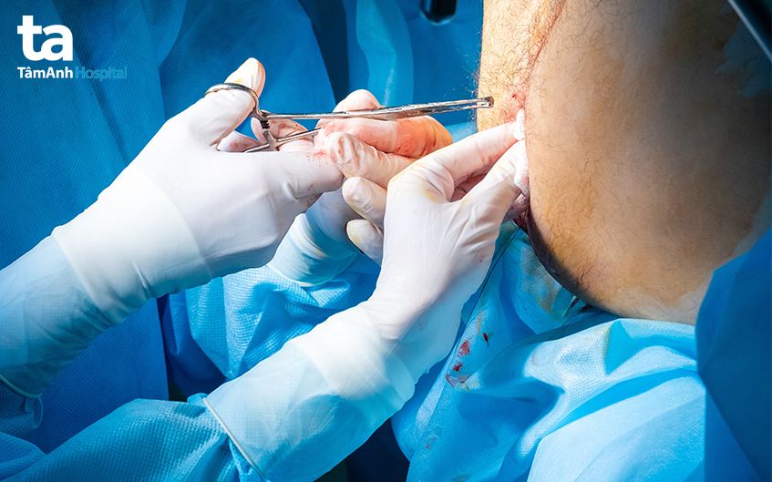 phẫu thuật polyp hậu môn