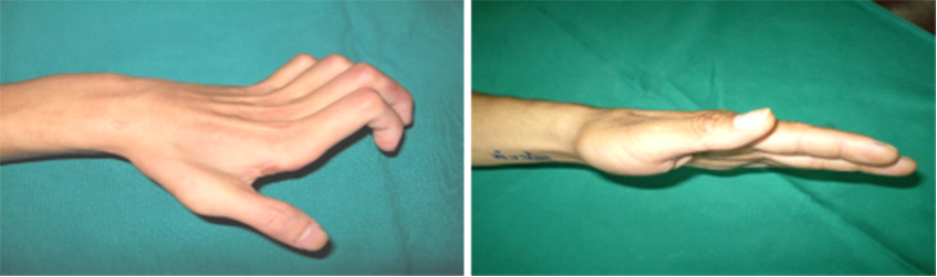 phẫu thuật zancolli