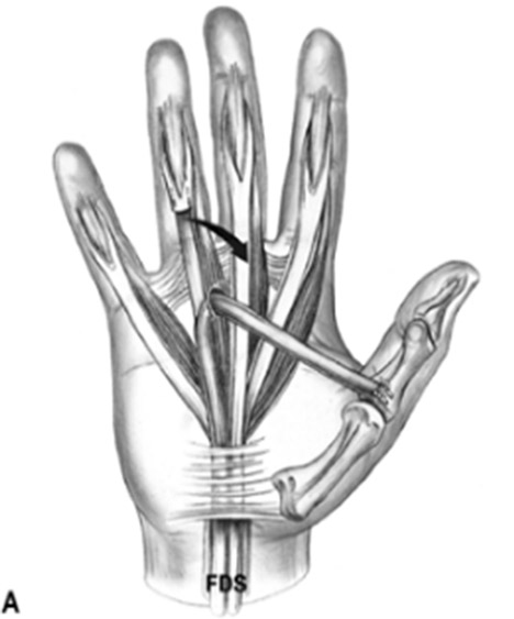 phục hồi vận động ngón 1