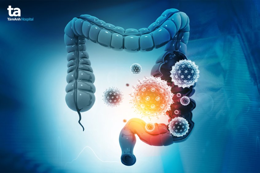 siêu âm đại tràng chẩn đoán bệnh gì