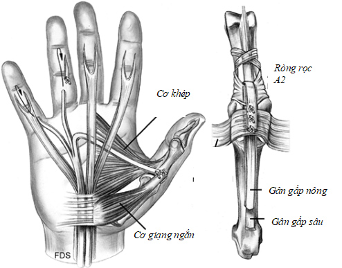 Hình 8: Sử dụng cơ gấp nông ngón III làm động lực khép ngón I và khắc phục biến dạng móng vuốt ngón IV,V (Hand surgery, 2004)