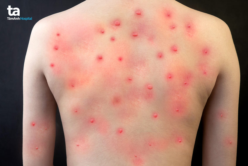 thuốc kháng virus brincidofovir