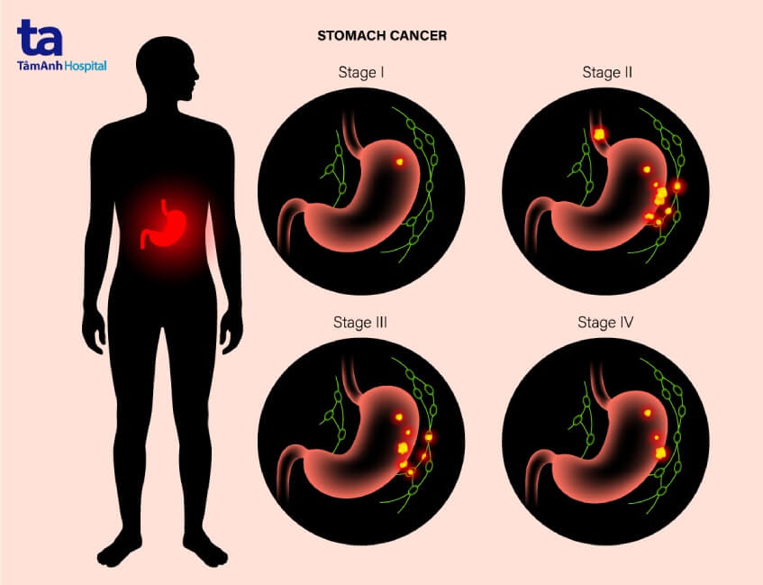 tiên lượng giai đoạn ung thư dạ dày