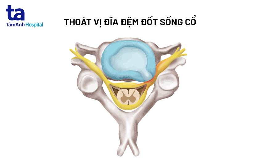 trượt đột sống cổ