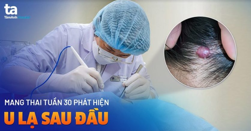 Mang thai tuần 30 phát hiện u màu đỏ sau đầu
