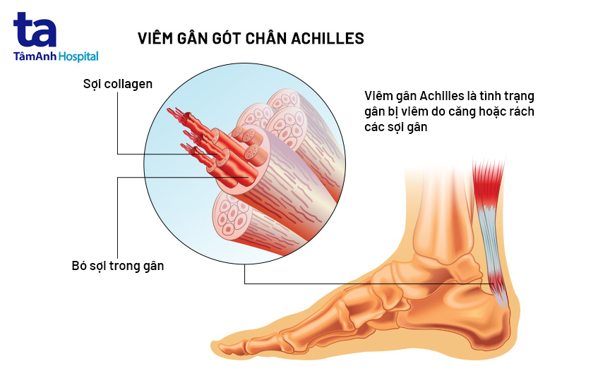 viêm gân achilles là gì