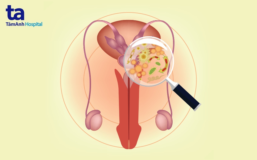 viêm tuyến tiền liệt cấp tính là gì