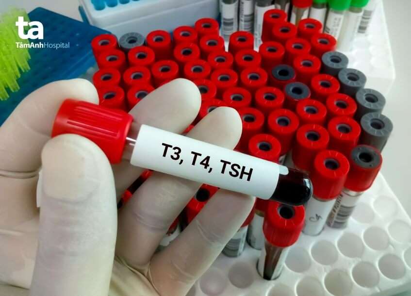 xét nghiệm đánh giá mức độ bướu cổ