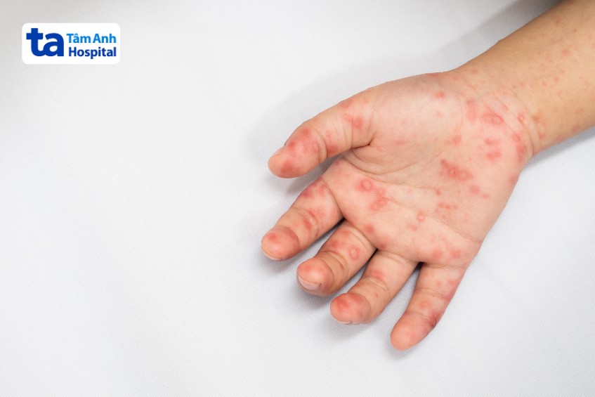 ban đỏ xuất hiện chủ yếu ở lòng bàn tay của trẻ sơ sinh