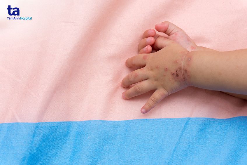 bệnh tay chân miệng có khả năng lây lan nhanh