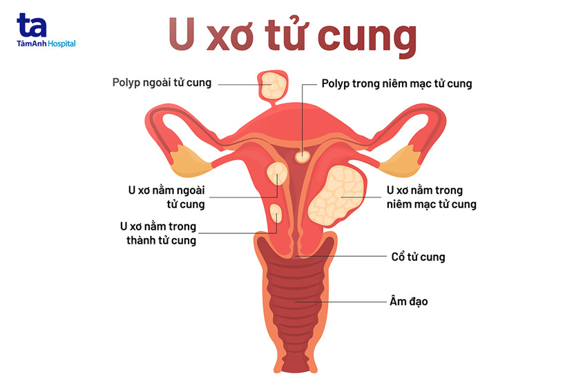 bệnh u xơ tử cung