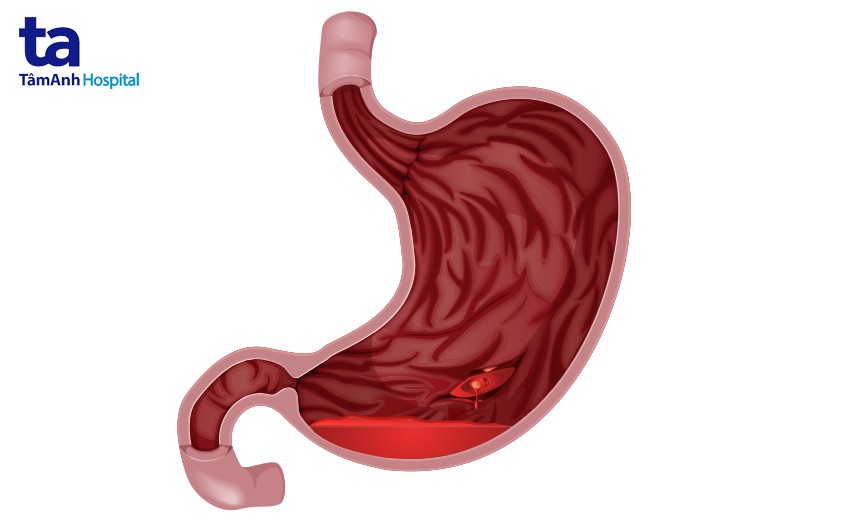 biến chứng xuất huyết tiêu hóa do viêm loét dạ dày tá tràng