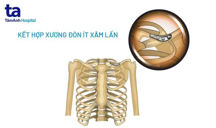 cố định ổ gãy xương