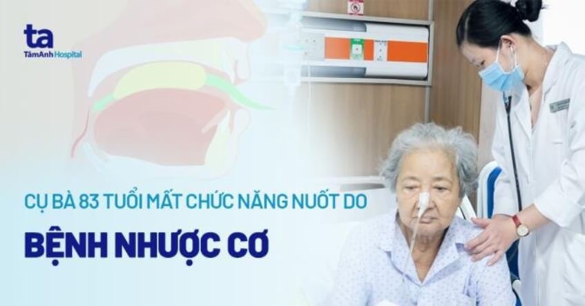 Cụ bà 83 tuổi mất chức năng nuốt do bệnh nhược cơ