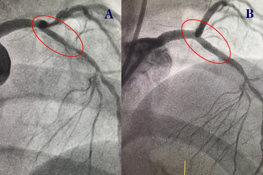 hình ảnh chẩn đoán xơ vữa nong mạch máu