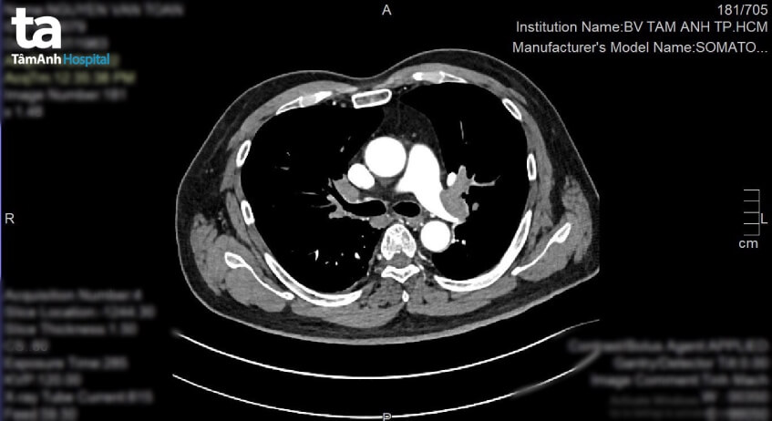 hình ảnh ct người bị thuyên tắc phổi