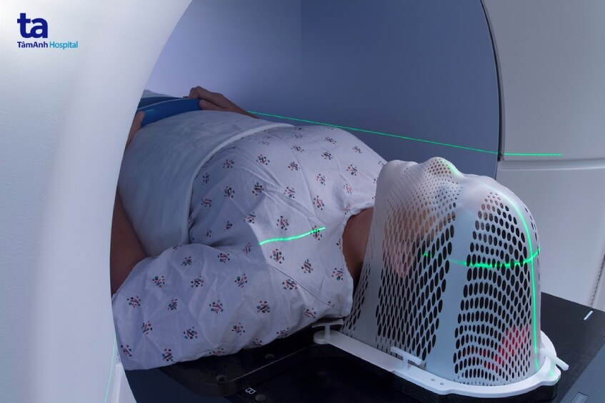 hình ảnh xạ trị u não lành tính