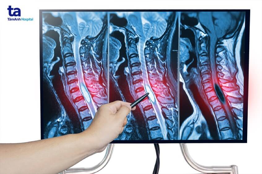 khối u tủy sống