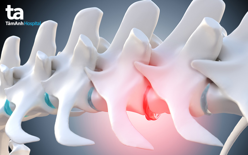 nguyên nhân khiến cột sống bị vôi hóa