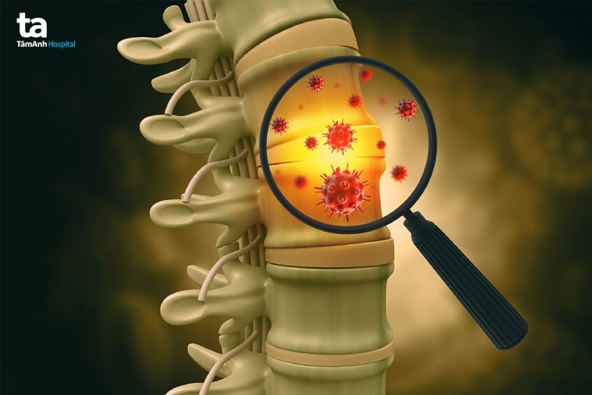 nguyên nhân u tủy sống