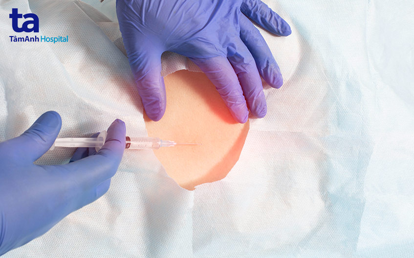 nội soi tiêm ngoài màng cứng