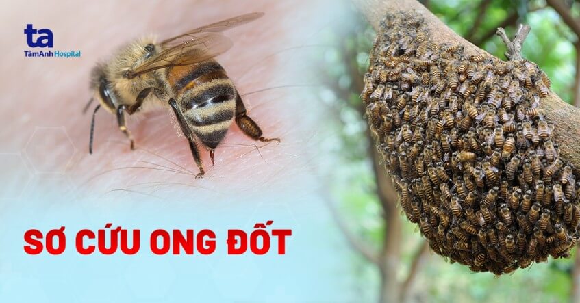 Cách xử lý khi bị ong đốt