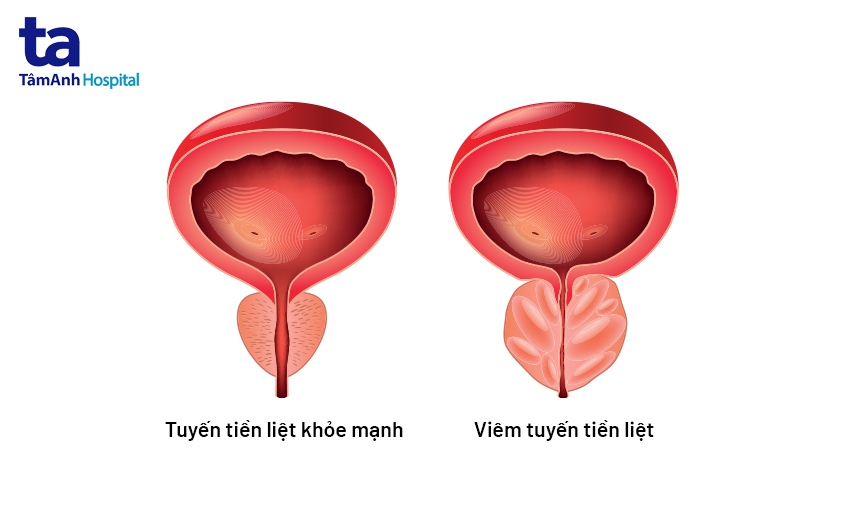 sơ lược về bệnh viêm tuyến tiền liệt mạn