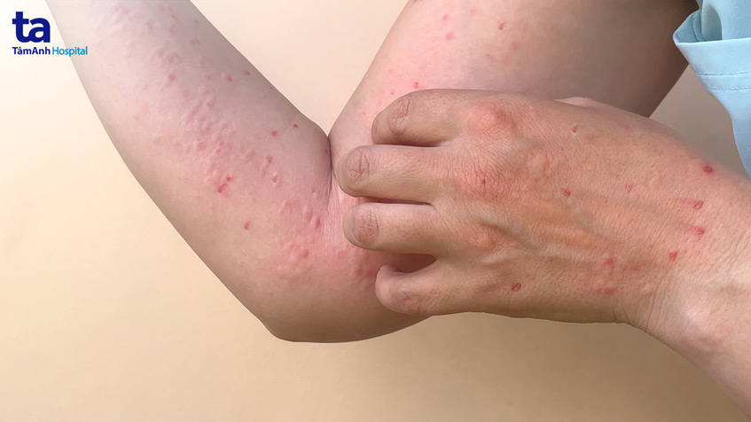 tiếp xúc với đồ dùng của bệnh nhân