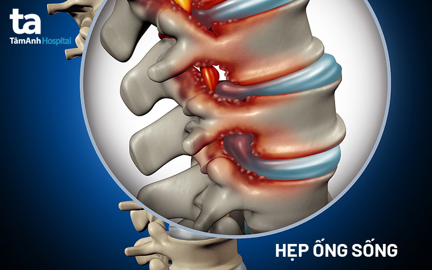 tình trạng hẹp ống sống
